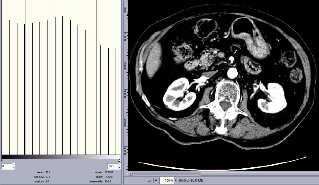 ct slice with very wide jagged histogram
