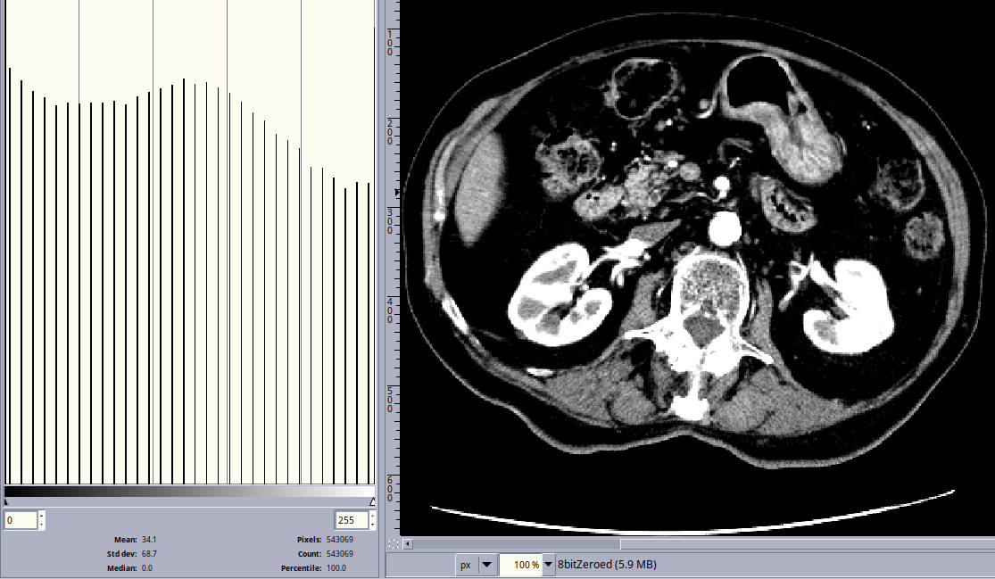 ct slice with wide jagged histogram