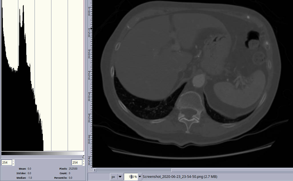 ct slice with histogram only showing values in the lower percentile